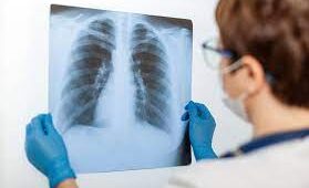 Пневмонія: основні симптоми та лікування